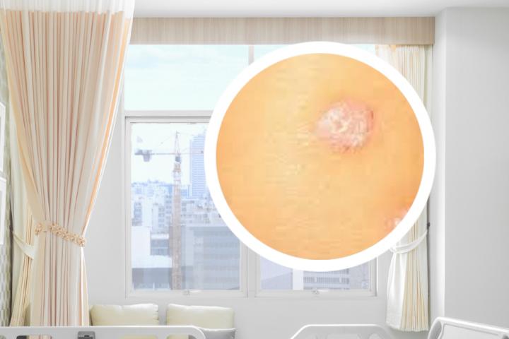 牛皮癣大腿严重