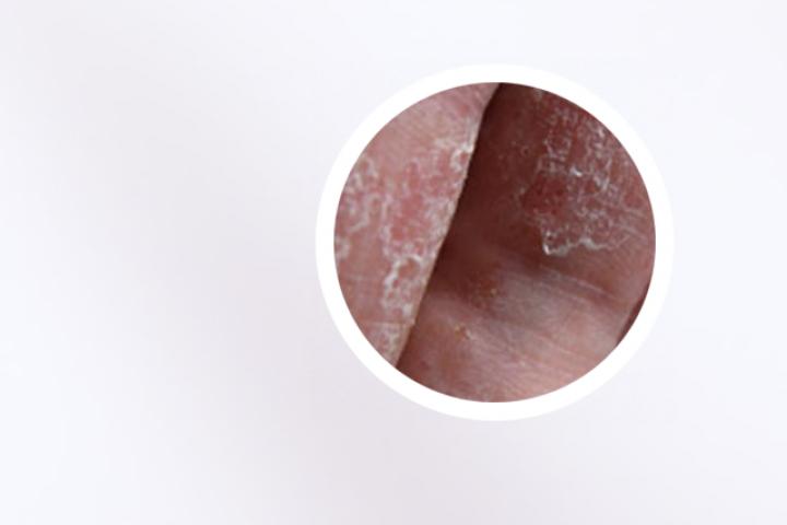 使用涂达力士治疗银屑病需要多少天才能见到效果