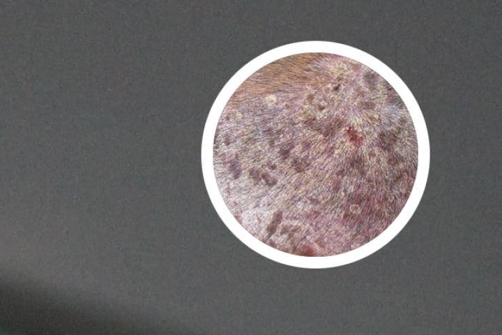 牛皮癣可以用电疗吗