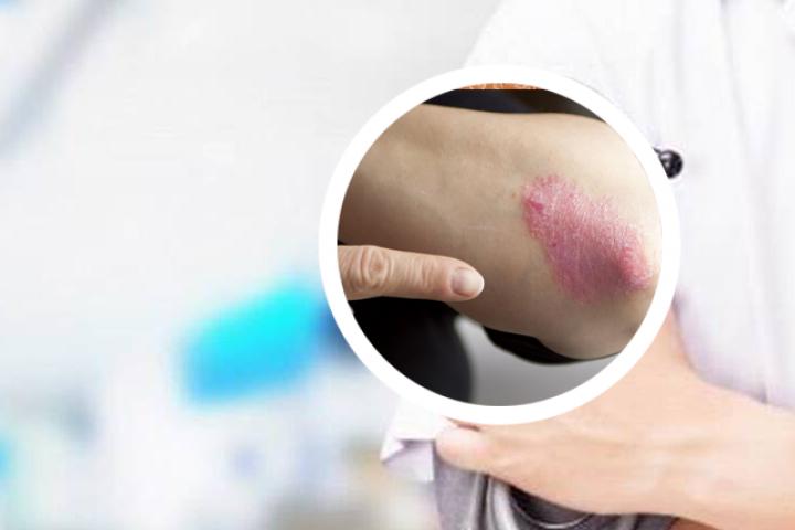 不是所有银屑病都复发