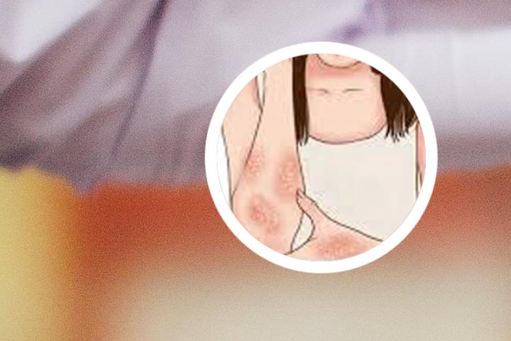 牛皮癣拔罐放血能好贴吧