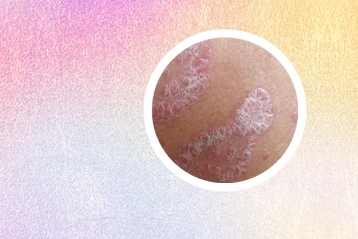 银屑病奇方秘方