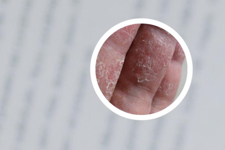 脸上银屑病用什么药膏