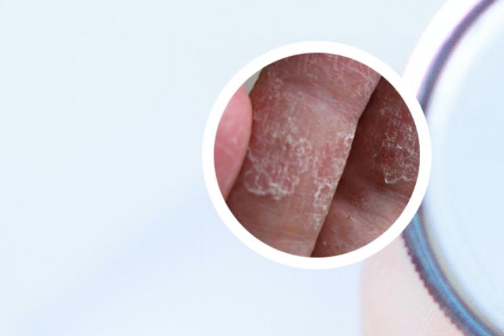 牛皮癣生物制剂是咋回事