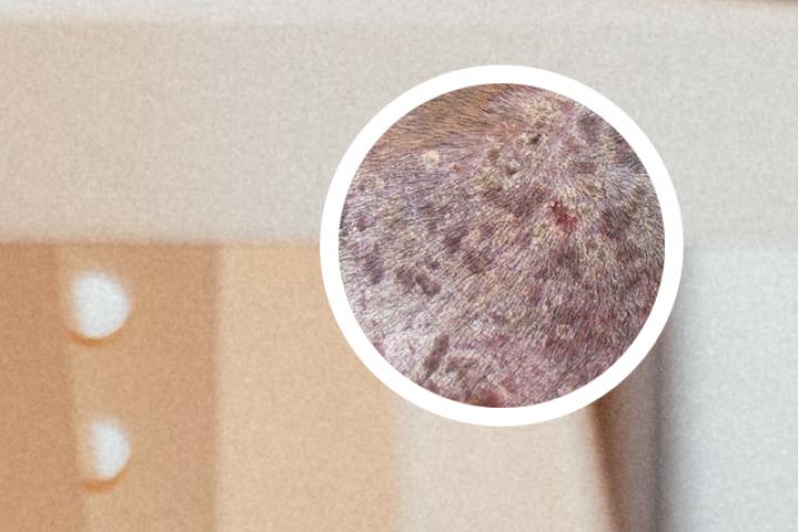 莱西市牛皮癣最新消息