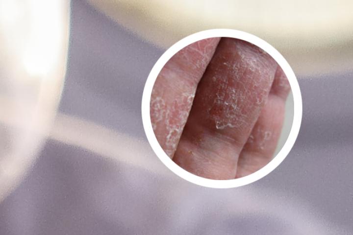 恩肤霜治疗头部牛皮癣吗