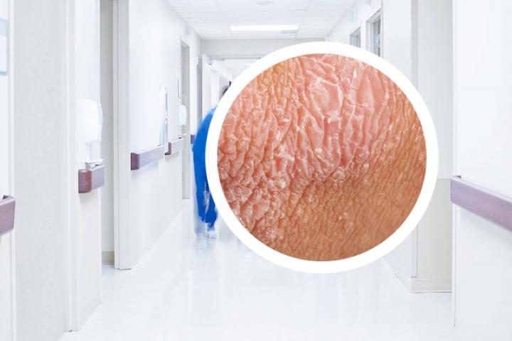 银屑病光疗不变黑