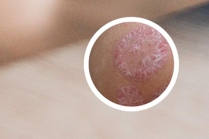 亚麻油能治疗牛皮癣吗