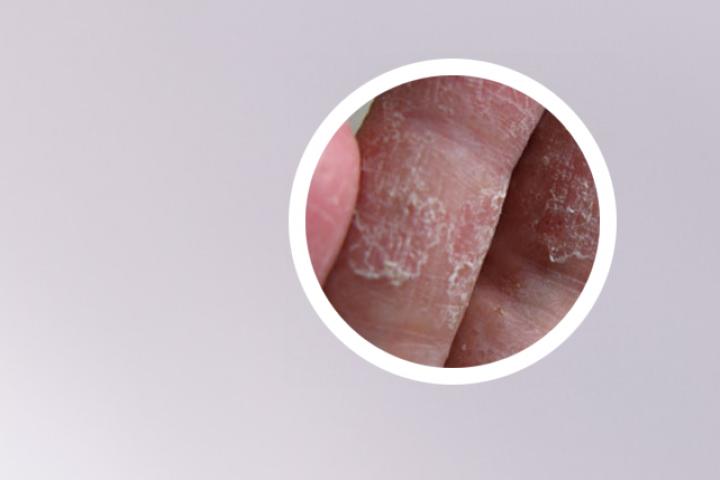 请问中药汤剂能否有效治疗银屑病
