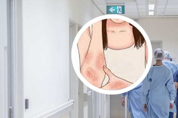 感染艾滋后银屑病消失了