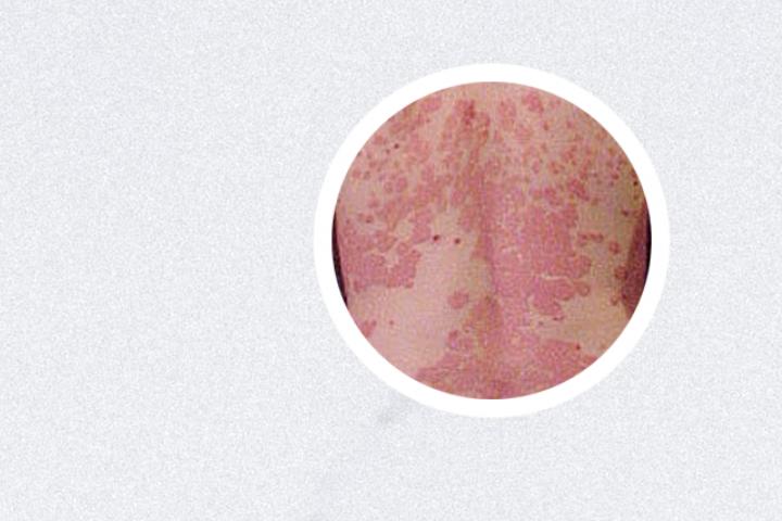 牛皮癣治疗用什么药膏