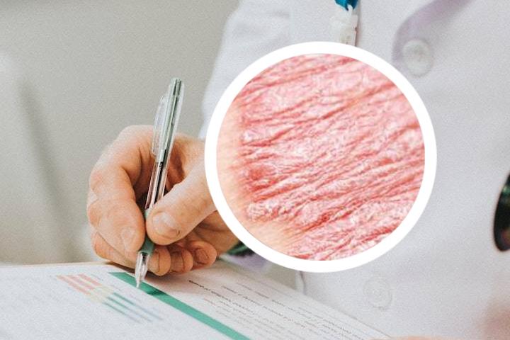 儿童银屑病可以断根吗