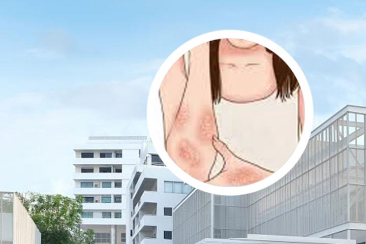 不忌口治疗牛皮癣真实吗