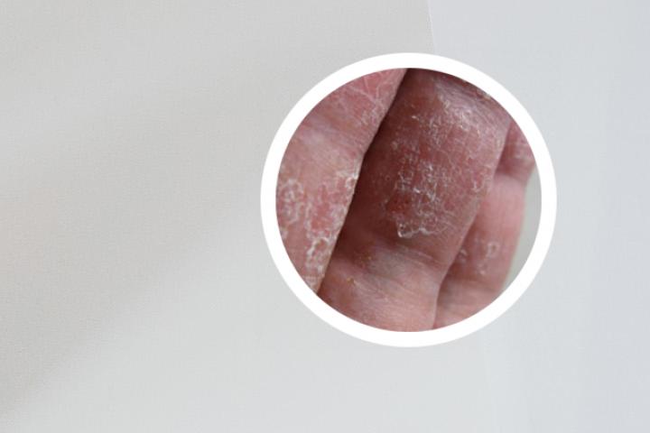 孕妇得了银屑病，生下的宝宝是否容易感染