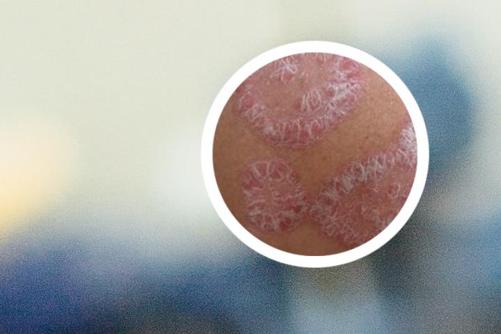 银屑病在病患部位拔罐可以吗