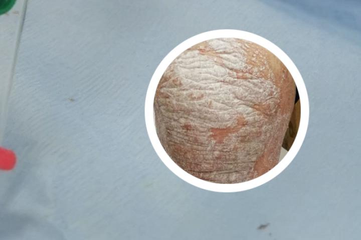 冬季牛皮癣犯了脚红肿疼