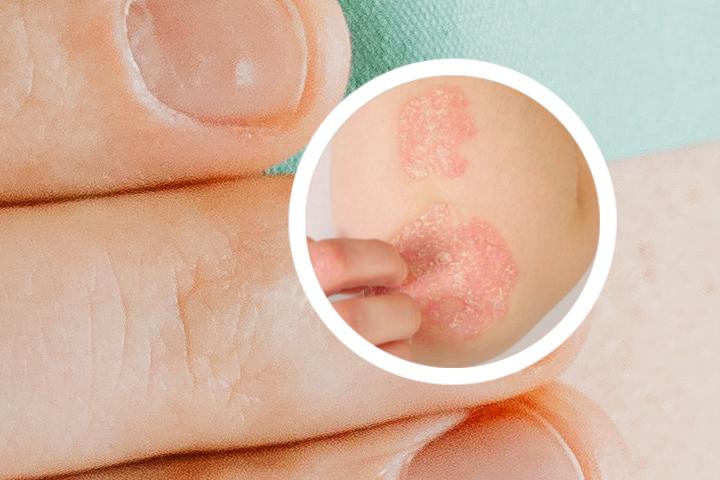 铜钱泡醋治牛皮癣