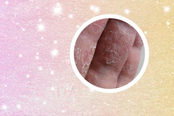 他克莫司软膏能治疗银屑病吗