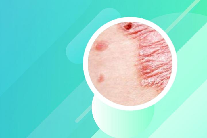铜对银屑病的治疗效果如何