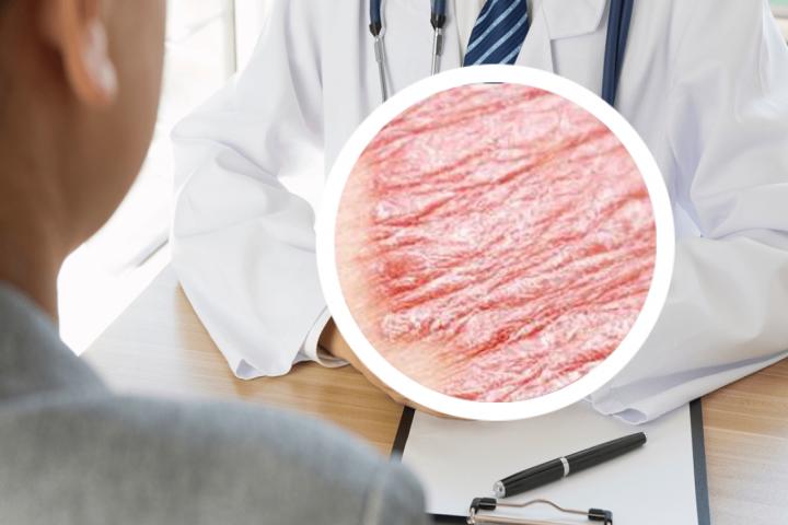 银屑病的原因怎样查