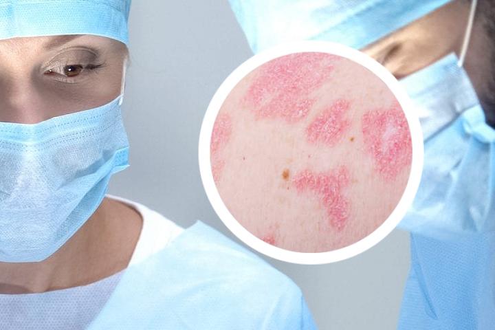 牛皮癣用什么药膏能治疗好
