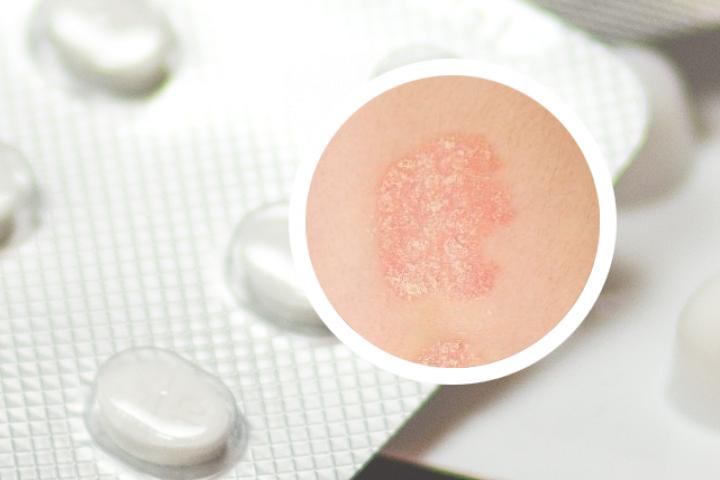 银屑病患者出现腹泻是否正常