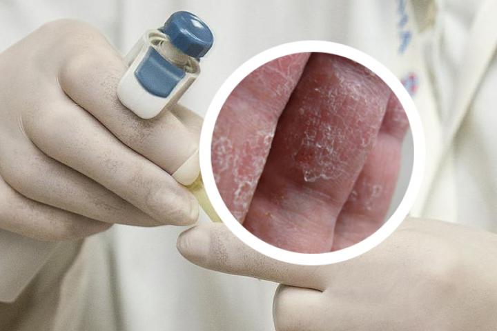 患有银屑病是否可以长期使用激素药物治疗