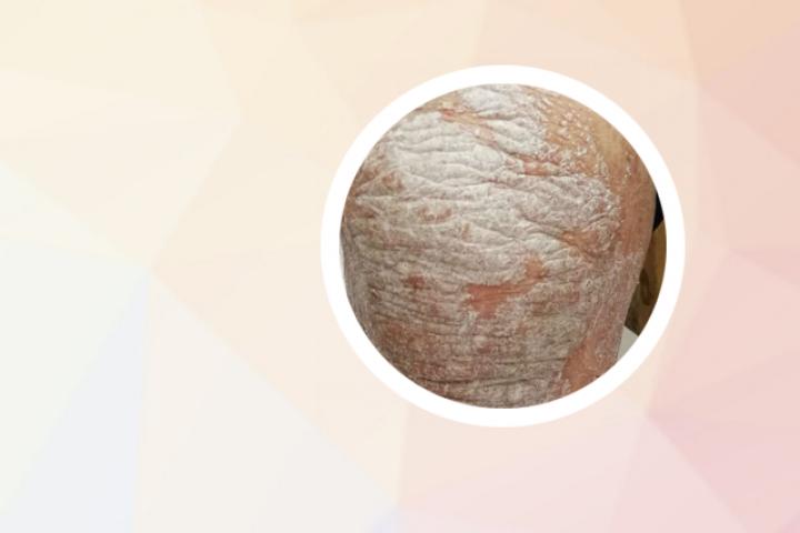 银屑病能吃蛋黄