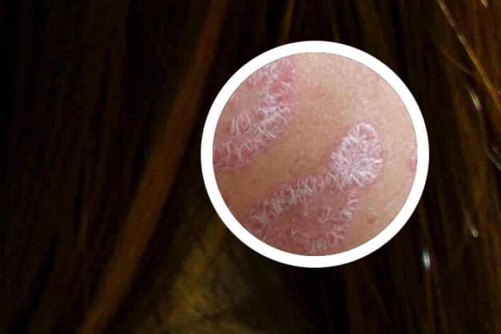 寻常型牛皮癣大病因