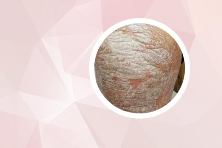 臭氧油能治好银屑病吗