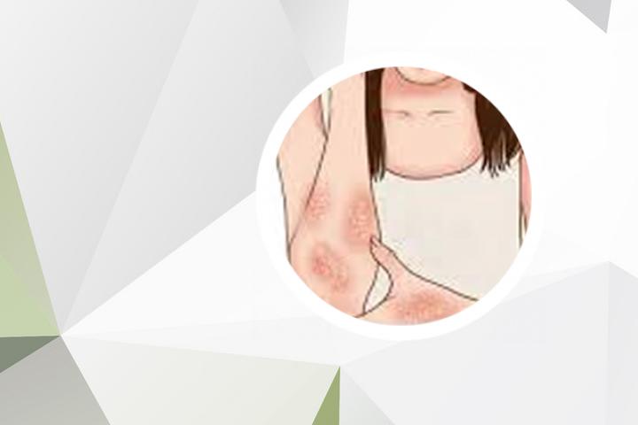 蔬菜汁牛皮癣治愈案例