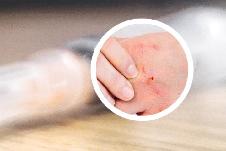 银屑病吃阿维A效果不明显咋回事