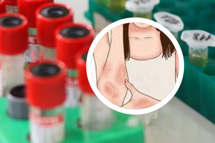 治银屑病的三个小偏方
