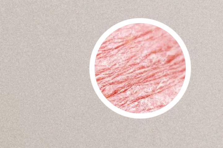 中医针灸能治牛皮癣