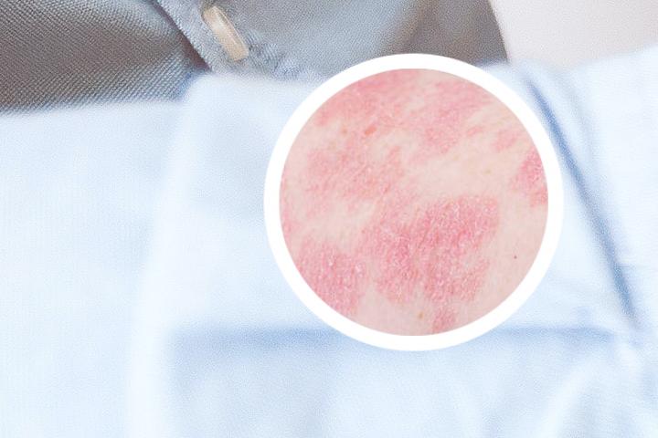 阿维a胶囊治银屑病的效果怎么样