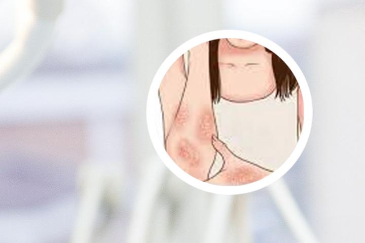 牛皮藓银屑病经常吃啥好