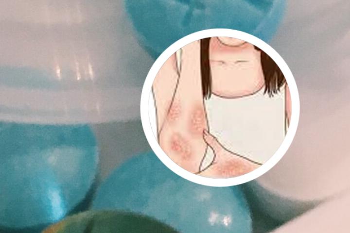 银屑病长全身会自动好吗