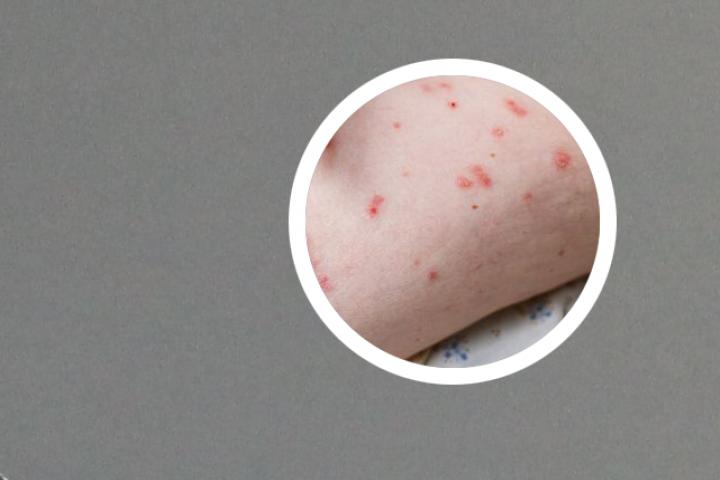 银屑病关节炎能治好吗