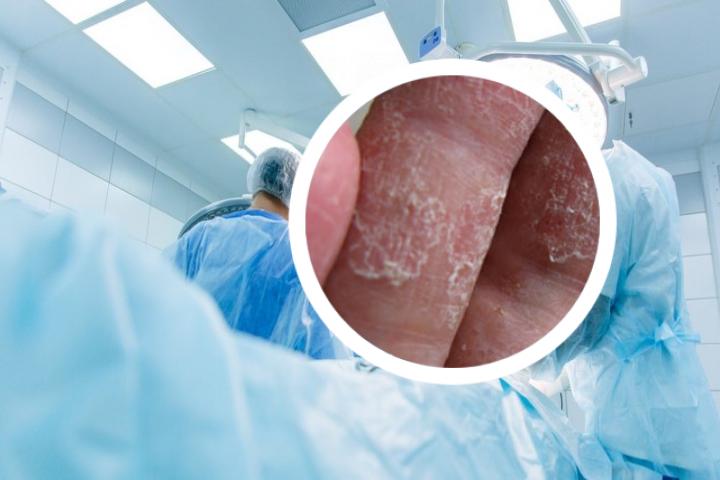 银屑病和角化型湿疹