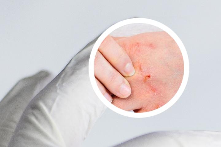 关节型银屑病病例