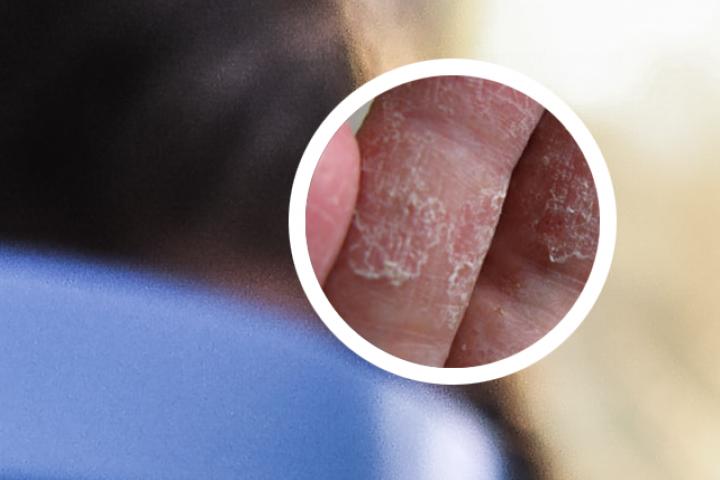 15岁女孩大腿银屑病该如何治疗