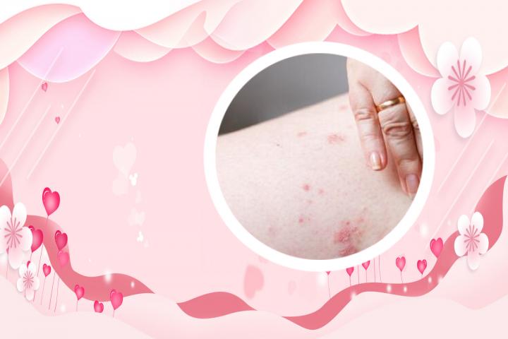 请问银屑病可以使用无激素外用软膏进行治疗吗