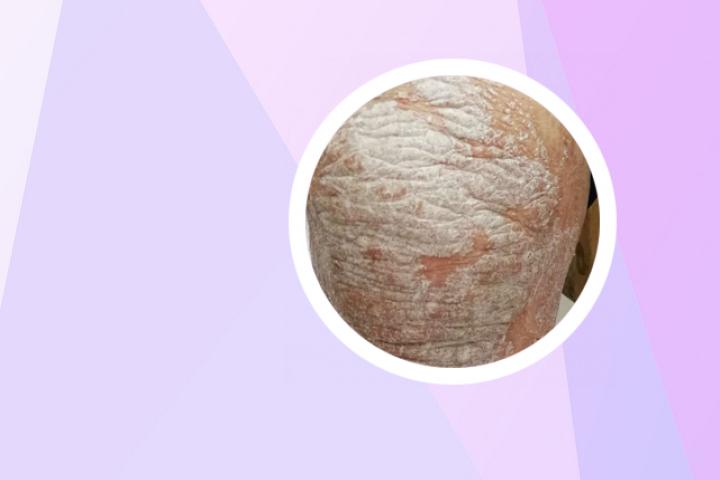 小孩子得银屑病的多吗