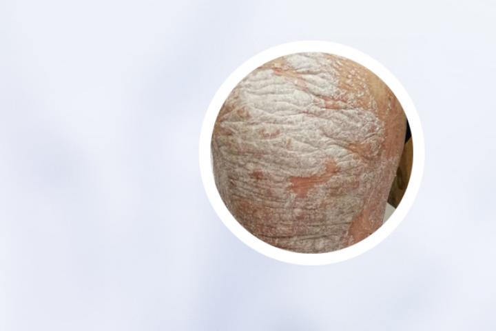 银屑病生物治疗最新进展