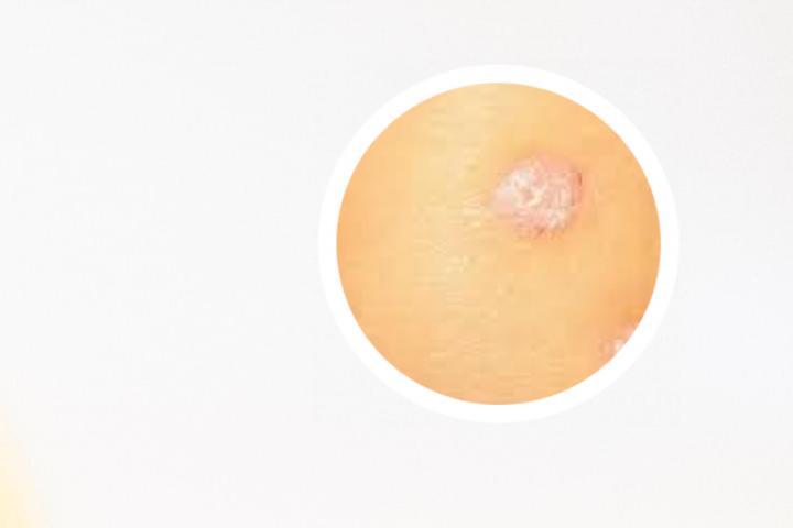 头皮银屑病复发特别痒