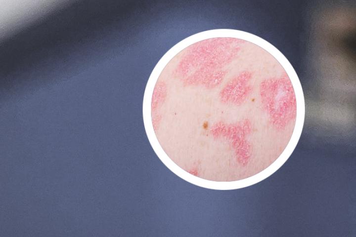 秋季牛皮癣患者吃什么好