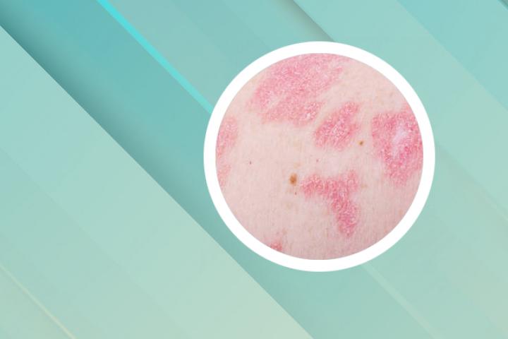 银屑病一边治愈一边起新的