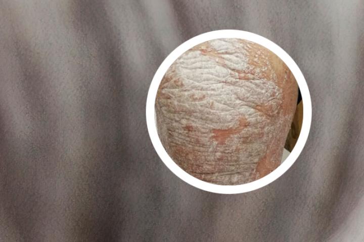 沈阳看牛皮癣递青菜不虚