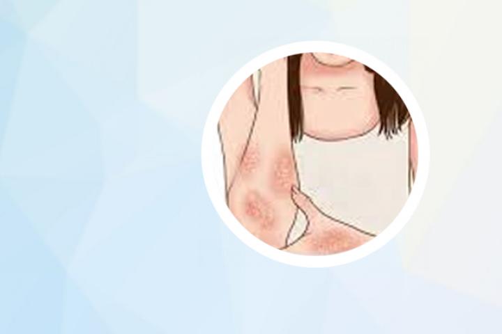 儿童银屑病的治疗体会