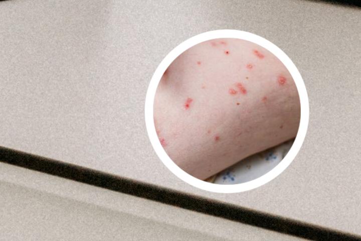 银屑病的中医辨证治疗
